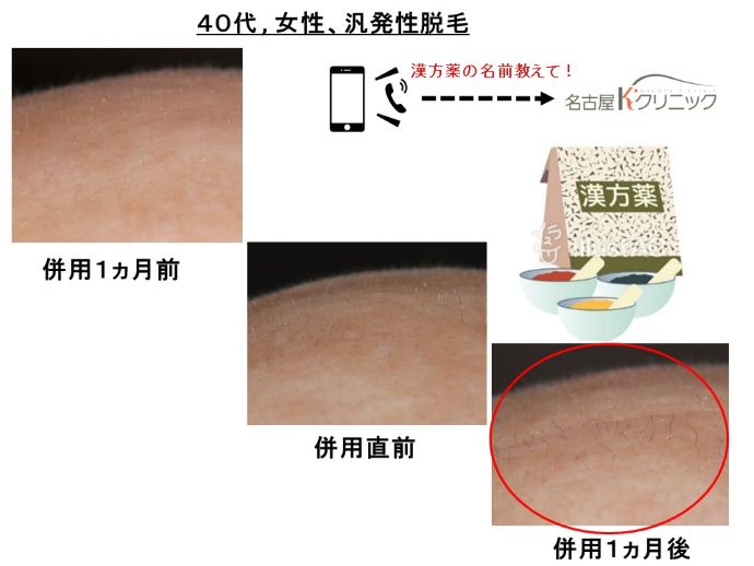 円形脱毛症　病院